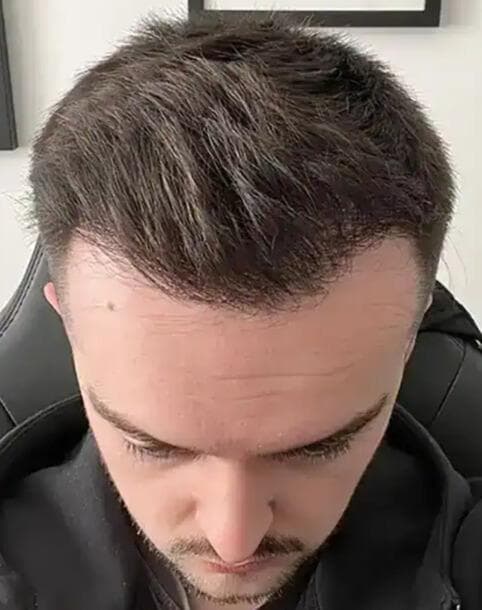 The Hairline Recovery - after