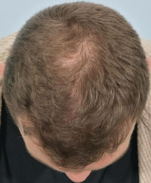 The Crown Restoration - before