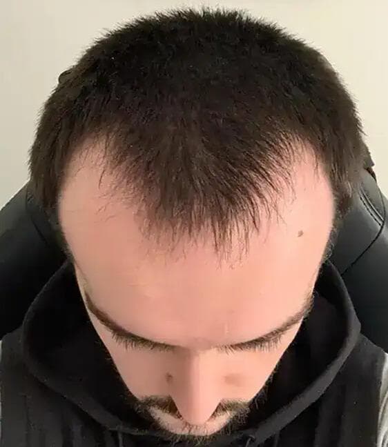 The Hairline Recovery - before